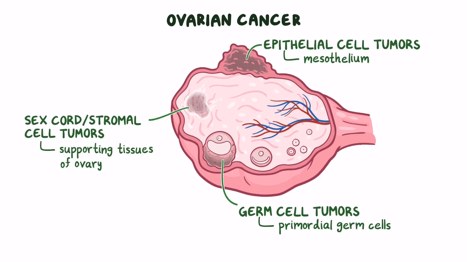 What is epithelial-to-mesenchymal transition (EMT)?
