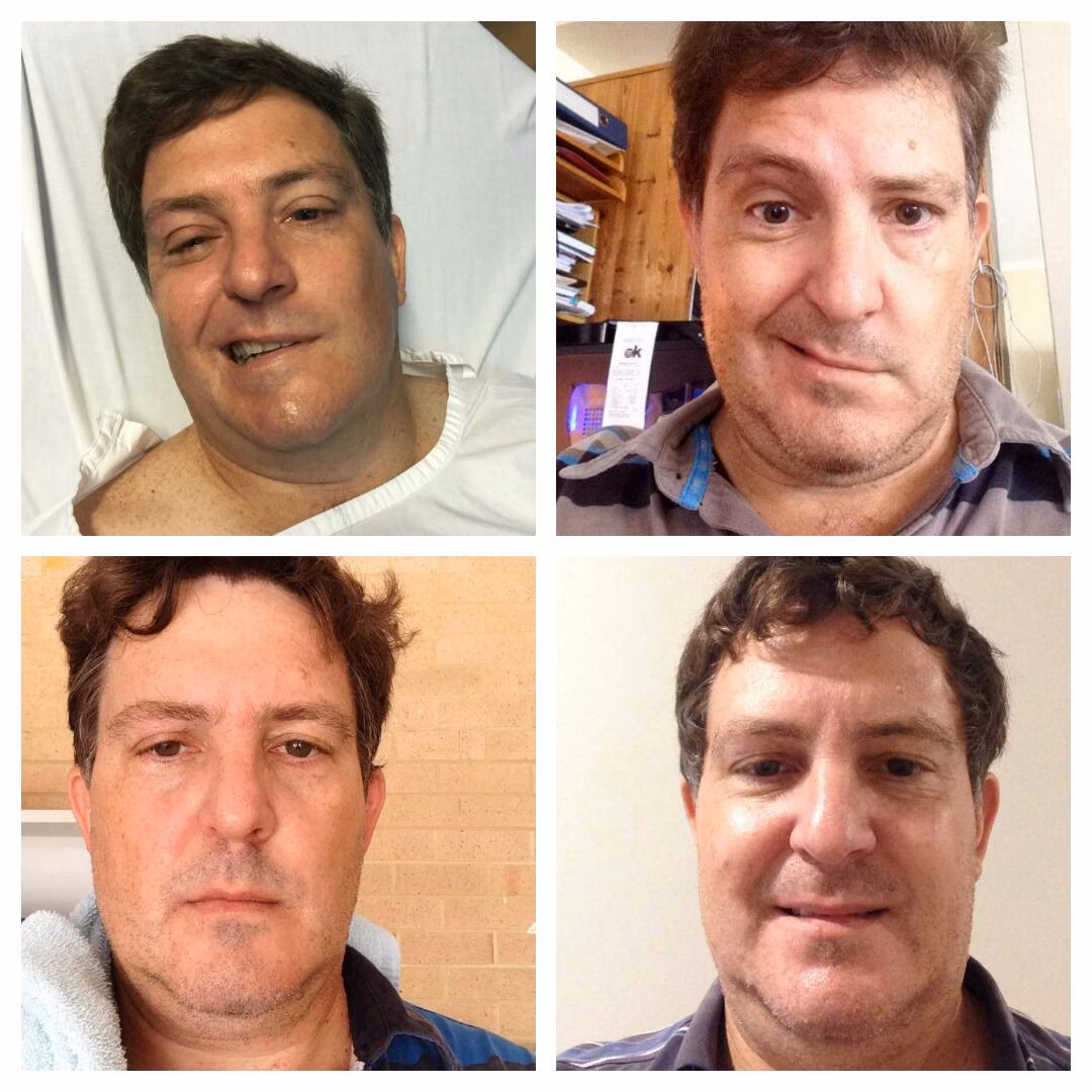 What happens if facial paralysis is left untreated?