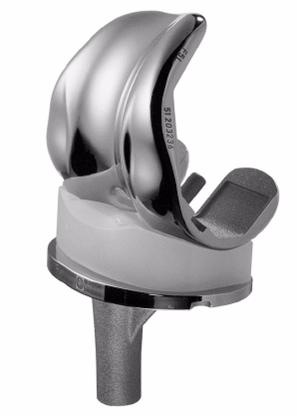 What is mobile bearing in total knee arthroplasty?