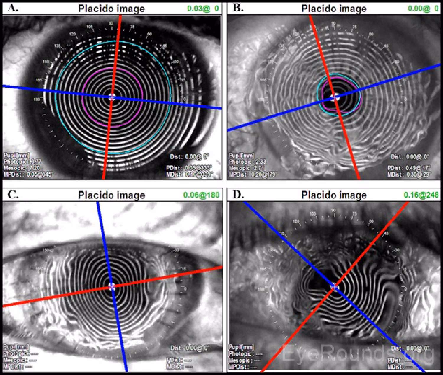 What is a Placido disc based topographer?